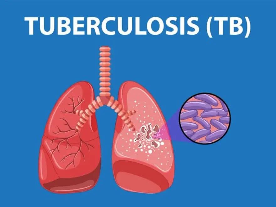 Country has Registered a Drop in Cases of Tuberculosis